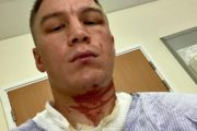 Казахстанского боксера облили похожим на кислоту веществом на сборах в Англии