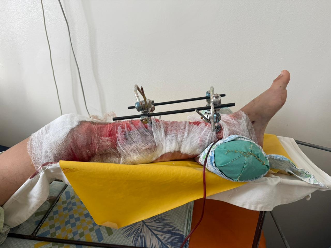 Рабочий завода «СарыаркаАвтоПром» получил серьёзную травму на производстве